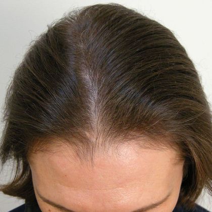Male Before And After Hair Transplant Photos Frontal Peak FUT - Before