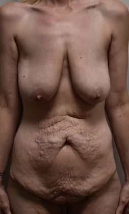 Massive Weight Loss : Case 74 - Before