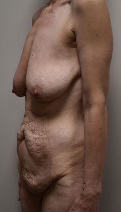 Mommy Makeover: Case 162 - Before