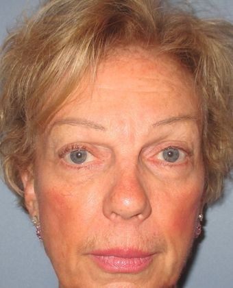 Lower Eyelid Surgery Case 16 - Before