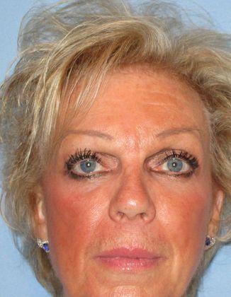 Lower Eyelid Surgery Case 16 - After