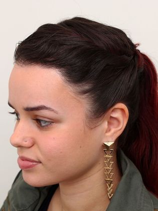 Hair Transplant - Female: Hairline FUT - After FUT hair transplant