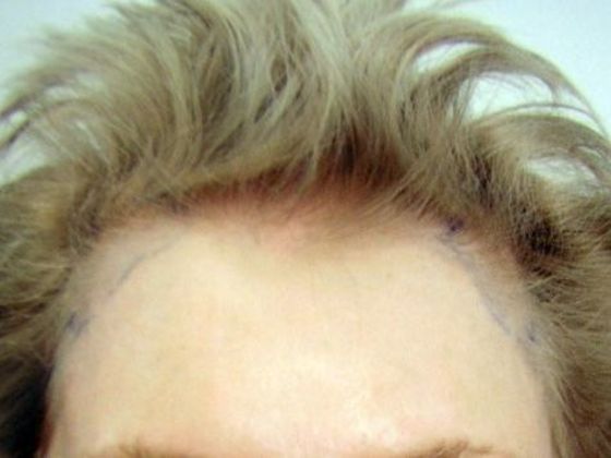 Hair Transplant - Female: Hairline FUT (6) - Before female hair transplant