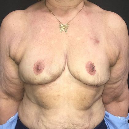 Goldilocks Breast Reconstruction Case 4 - After