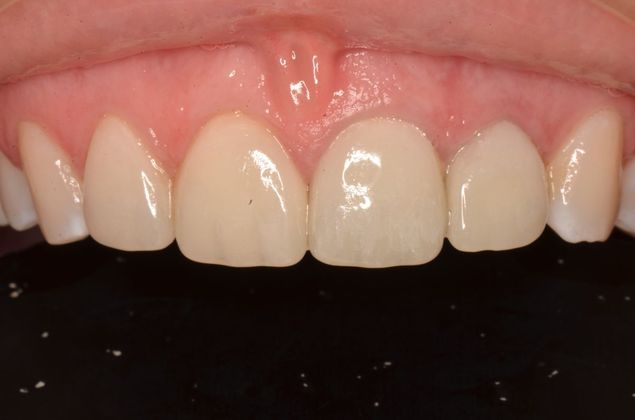 Dental Implants: Case 36 - After