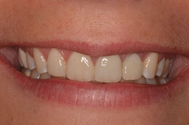 Dental Implants: Case 36 - After