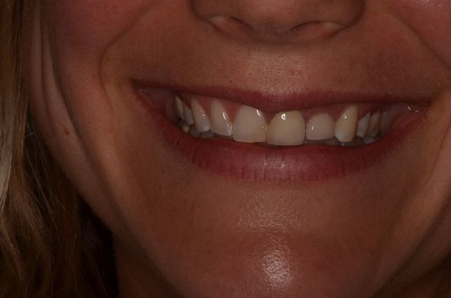 Dental Implants: Case 36 - Before