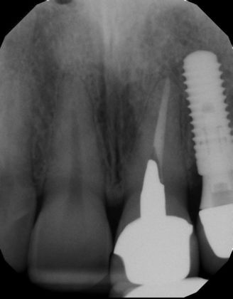 Dental Implants: Case 36 - Before