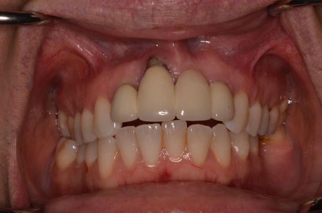 Bridges: Case 5 - Before