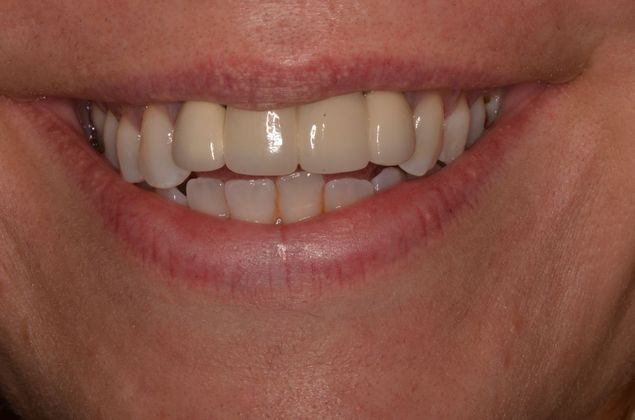 Bridges: Case 5 - After