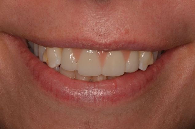 Bridges: Case 5 - After