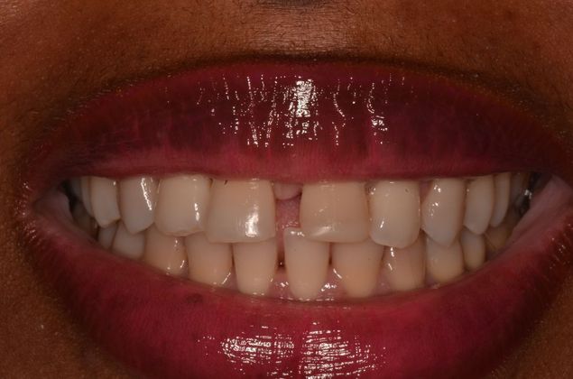 Composite Bonding: Case 6 - Before