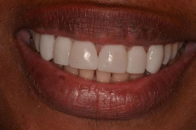 Composite Bonding: Case 6 - After