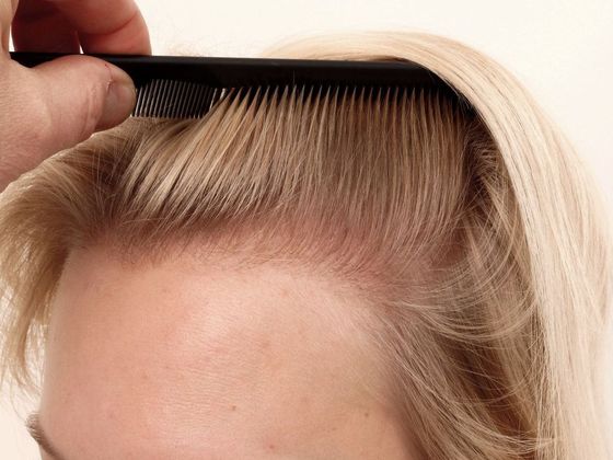 Hair Transplant - Female: Hairline FUT (10) - After female hair transplant