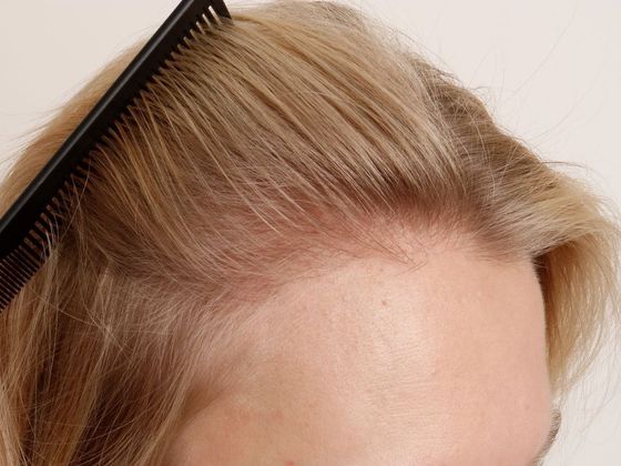 Hair Transplant - Female: Hairline FUT (10) - After female hair transplant