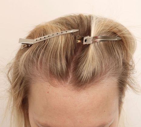 Hair Transplant - Female: Hairline FUT (10) - After female hair transplant