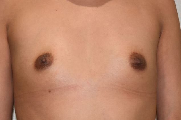 Breast Augmentation Case 603 - Before