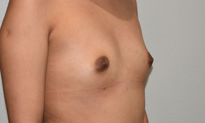 Breast Augmentation: Case 603 - Before