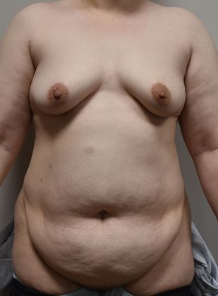 Mommy Makeover Case 163 - Before