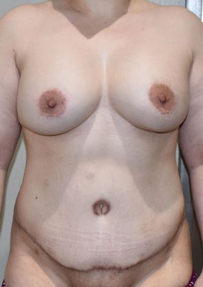 Mommy Makeover Case 163 - After