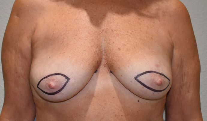 Breast Reconstruction Case 70 - Before