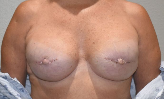 Breast Reconstruction Case 70 - After