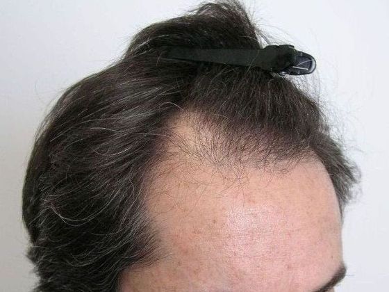 Hair Transplant - Male: Hairline FUT - Case 34 - Before FUT hair transplant