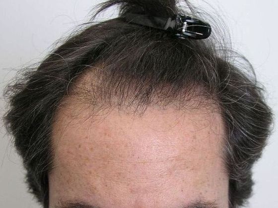 Male Before And After Hair Transplant Photos Hairline FUT (2) - Before