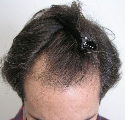 Hair Transplant - Male: Hairline FUT - Case 34 - Before FUT hair transplant