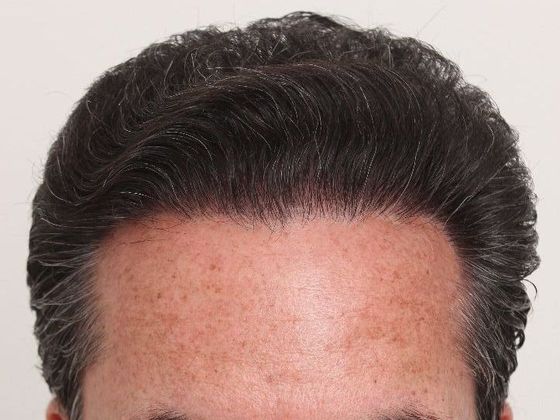 Male Before And After Hair Transplant Photos Hairline FUT (2) - After