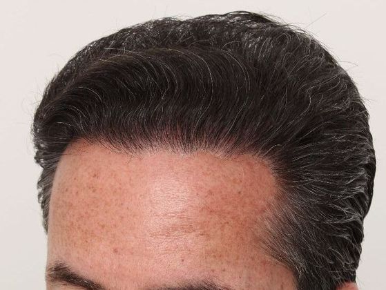 Hair Transplant - Male: Hairline FUT - Case 34 - After FUT hair transplant