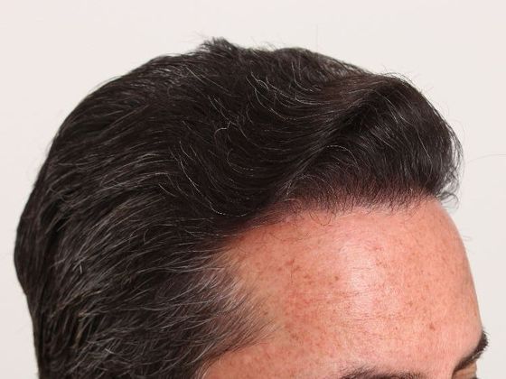 Hair Transplant - Male: Hairline FUT - Case 34 - After FUT hair transplant