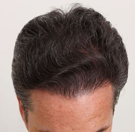 Hair Transplant - Male: Hairline FUT - Case 34 - After FUT hair transplant
