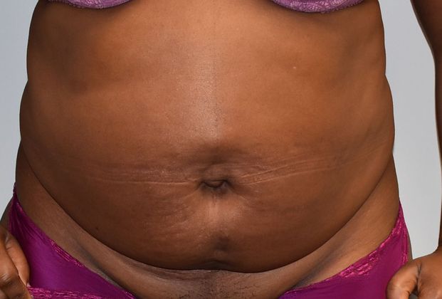 Tummy Tuck (Abdominoplasty): Case 240 - Before