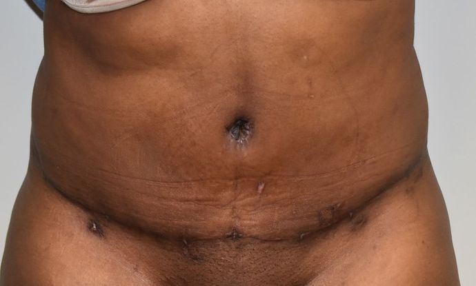Tummy Tuck (Abdominoplasty): Case 240 - After