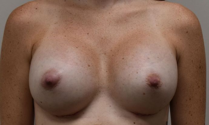 Breast Augmentation Case 607 - After