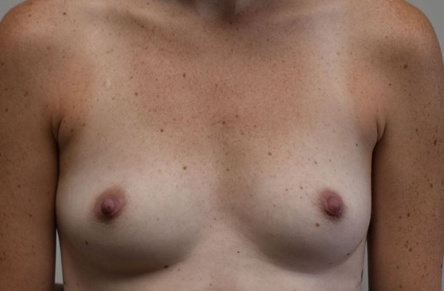Breast Augmentation Case 607 - Before