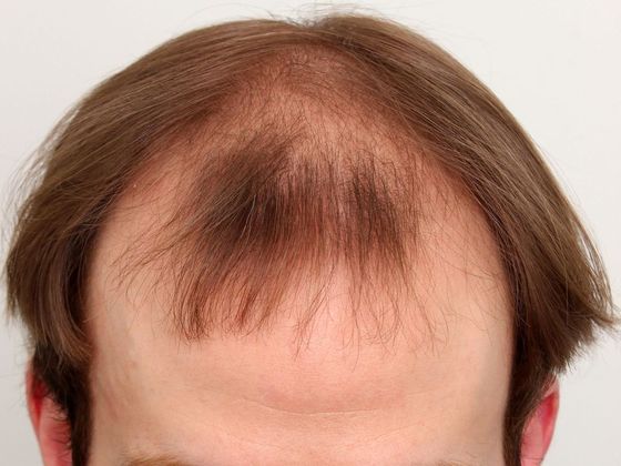 Hair Transplant - Male: Front & Top FUT - Case 47 - Before FUT hair transplant