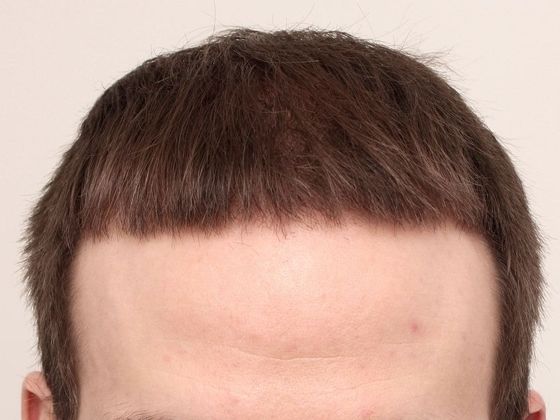 Hair Transplant - Male: Front & Top FUT - Case 47 - After FUT hair transplant