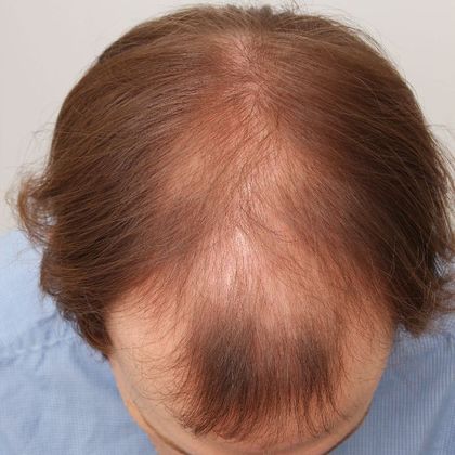Male Before And After Hair Transplant Photos Front & Top FUT (2)  - Before