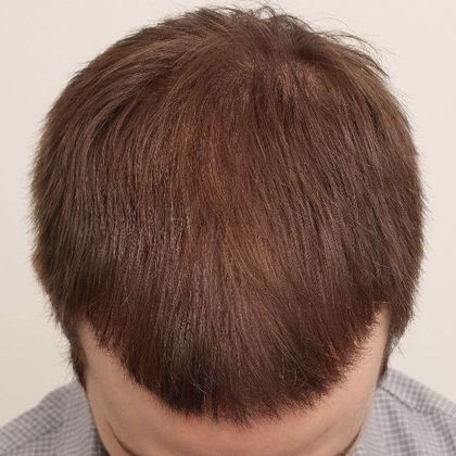Male Before And After Hair Transplant Photos Front & Top FUT (2)  - After