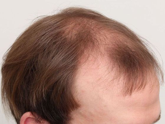 Hair Transplant - Male: Front & Top FUT - Case 47 - Before FUT hair transplant