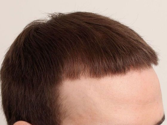 Hair Transplant - Male: Front & Top FUT - Case 47 - After FUT hair transplant