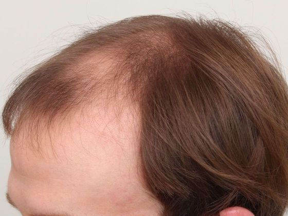 Hair Transplant - Male: Front & Top FUT - Case 47 - Before FUT hair transplant