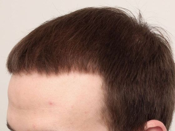 Hair Transplant - Male: Front & Top FUT - Case 47 - After FUT hair transplant