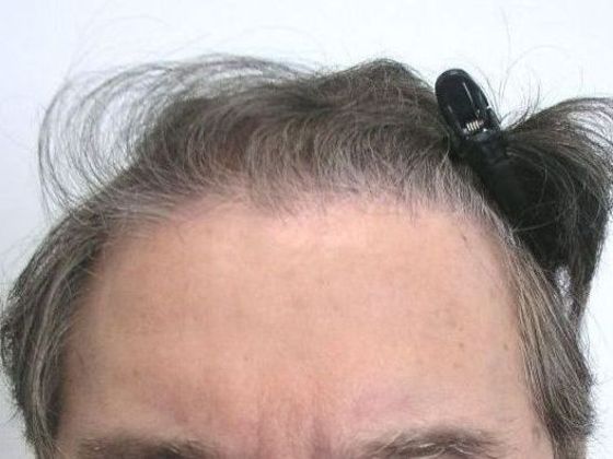 Hair Transplant - Male: Front & Top - Case 49 - Before FUT hair transplant