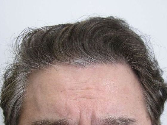 Hair Transplant - Male: Front & Top - Case 49 - After FUT hair transplant