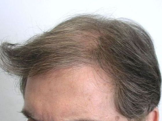 Hair Transplant - Male: Front & Top - Case 49 - Before FUT hair transplant