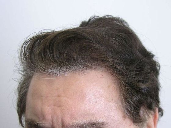 Hair Transplant - Male: Front & Top - Case 49 - After FUT hair transplant