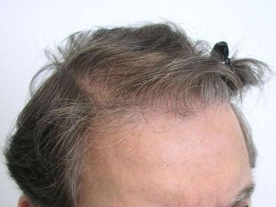 Male Before And After Hair Transplant Photos Front & Top (4) - Before